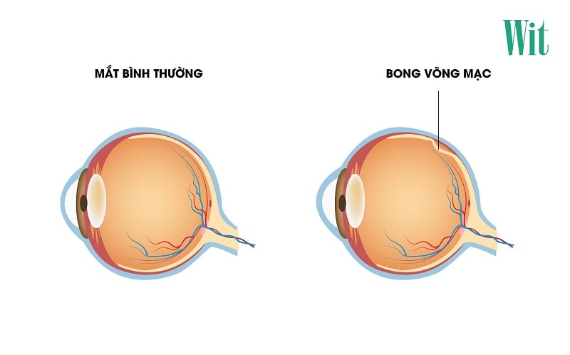 Bong võng mạc là gì? Bong võng mạc có chữa được không?
