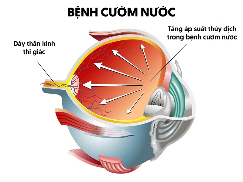 cườm nước là gì