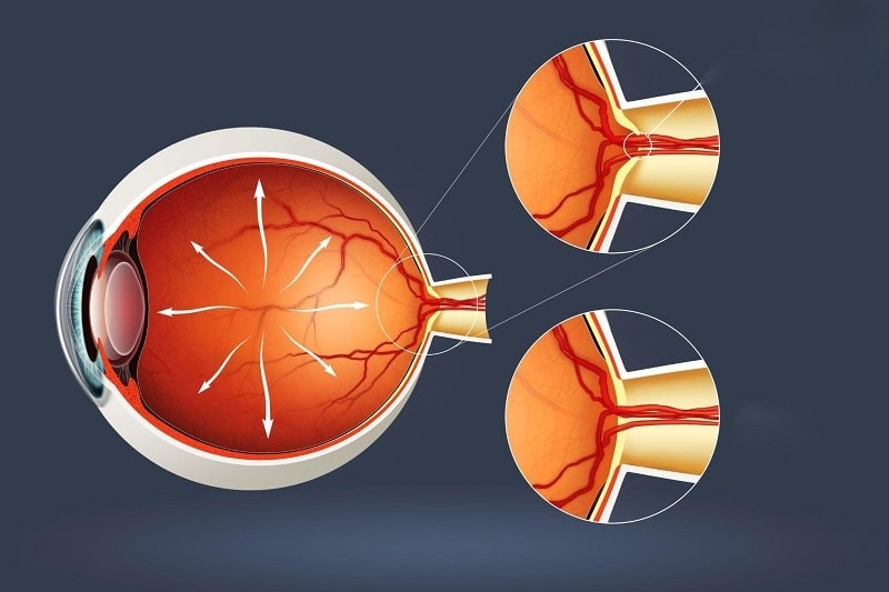 Cườm nước nghiêm trọng hơn vì áp lực nội nhãn tăng đột ngột dễ gây mù lòa vĩnh viễn