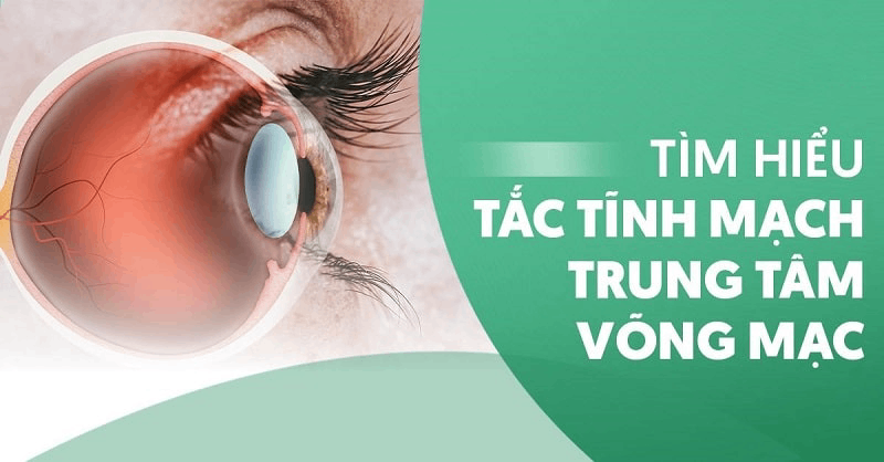 Tắc tĩnh mạch trung tâm võng mạc: Triệu chứng và cách điều trị
