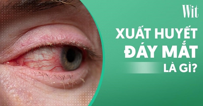 Xuất huyết đáy mắt là gì