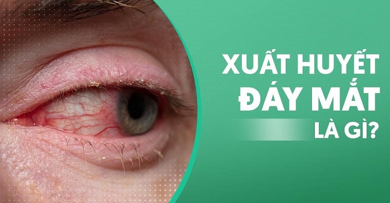 xuất huyết đáy mắt là gì