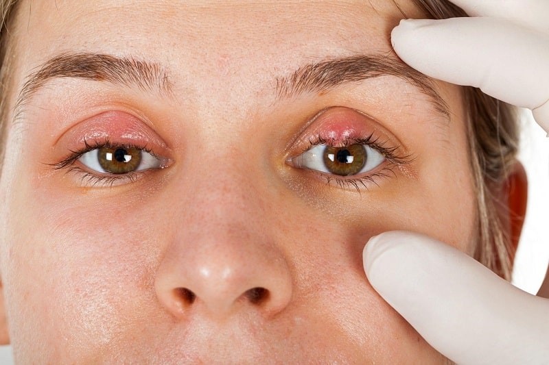 Viêm bờ mi trên có thể gây lẹo, chắp nếu không được điều trị kịp thời