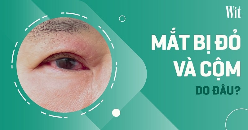 Mắt bị đỏ và cộm: Nguyên nhân do đâu, cách xử lý như thế nào?