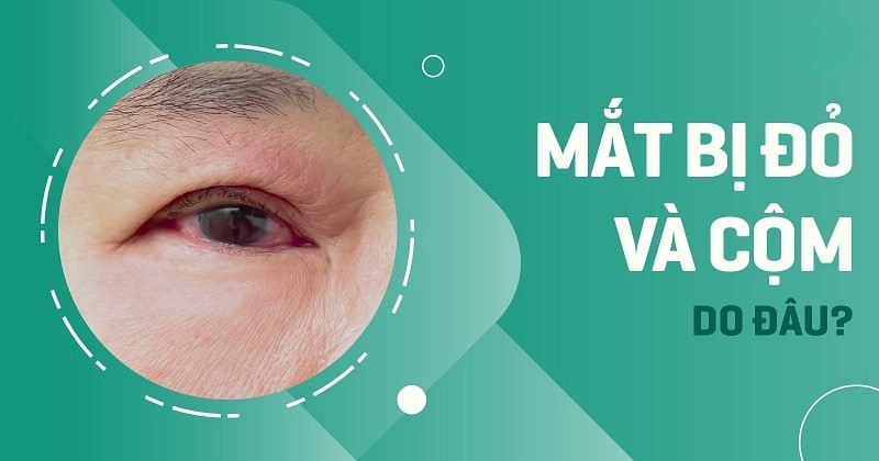 Mắt bị đỏ và cộm: Nguyên nhân do đâu, cách xử lý như thế nào?
