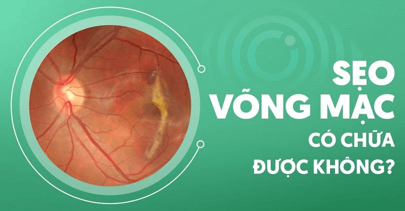 Sẹo võng mạc có chữa được không? Nguyên nhân là gì?