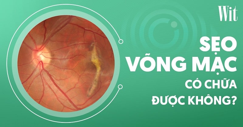 Sẹo võng mạc có chữa được không? Nguyên nhân là gì?