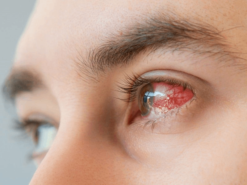 biểu hiện rách võng mạc