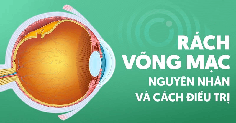 rách võng mạc là gì