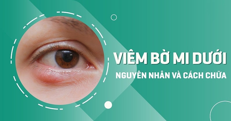 Viêm bờ mi dưới: Nguyên nhân do đâu và cách chữa trị thế nào?