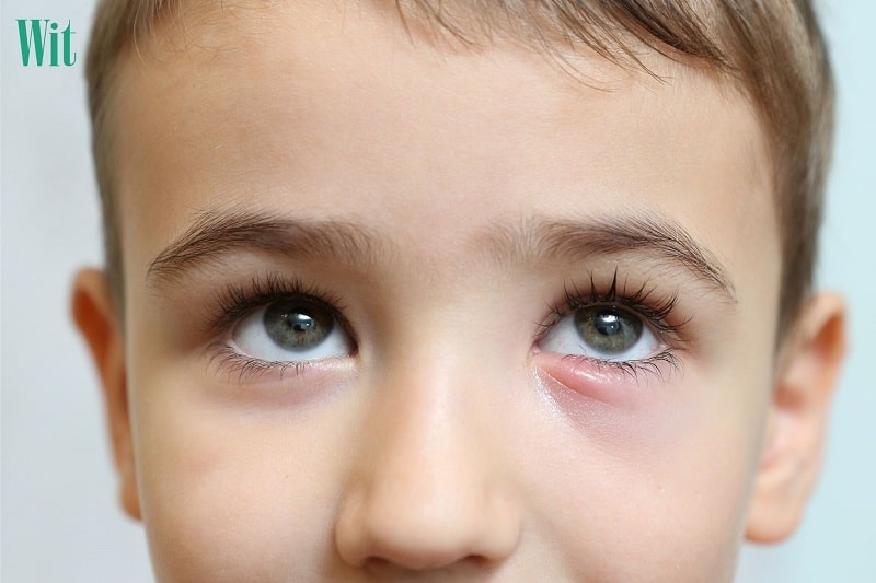 Bệnh viêm bờ mi mắt dưới là gì?