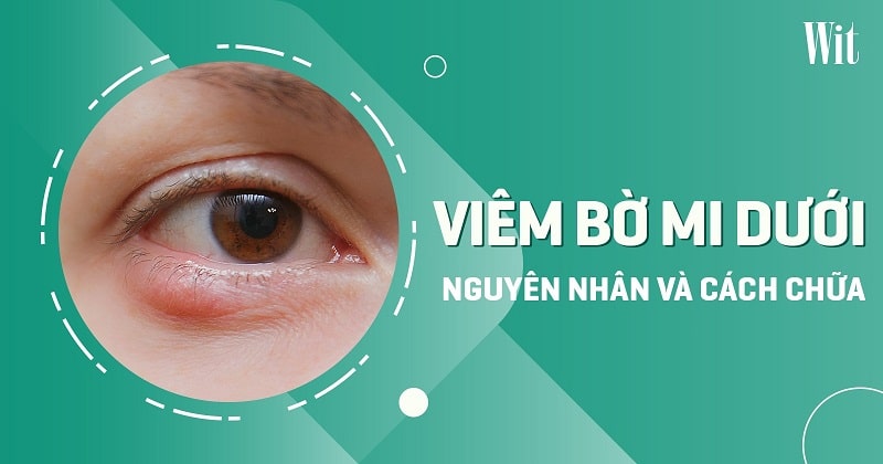 Viêm bờ mi dưới: Nguyên nhân do đâu và cách chữa trị thế nào?