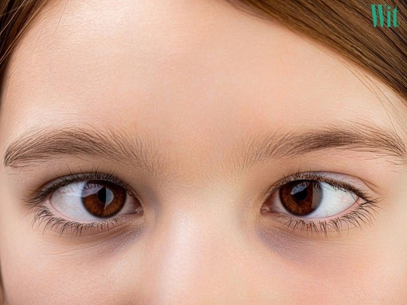 Nguyên nhân dẫn đến bệnh nhược thị