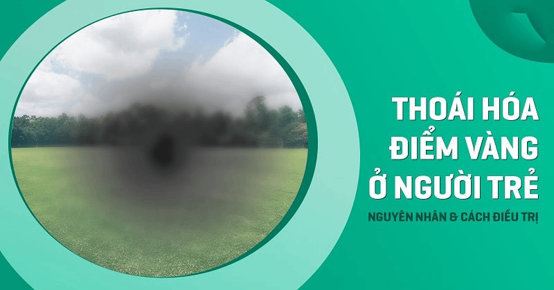 thoái hóa điểm vàng ở người trẻ