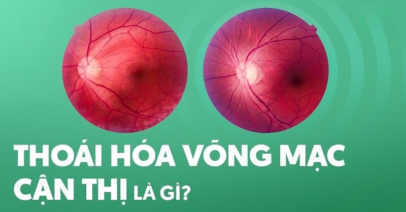 thoái hóa võng mạc cận thị