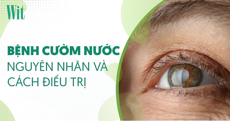 Bệnh cườm nước