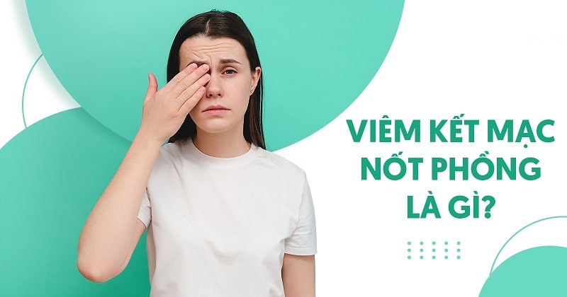 Viêm kết mạc nốt phồng: Nguyên nhân, dấu hiệu và cách điều trị