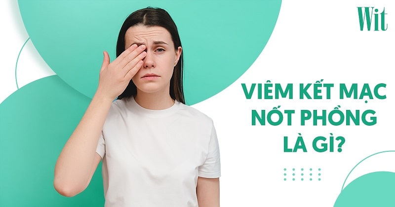 Viêm kết mạc nốt phồng: Nguyên nhân, dấu hiệu và cách điều trị