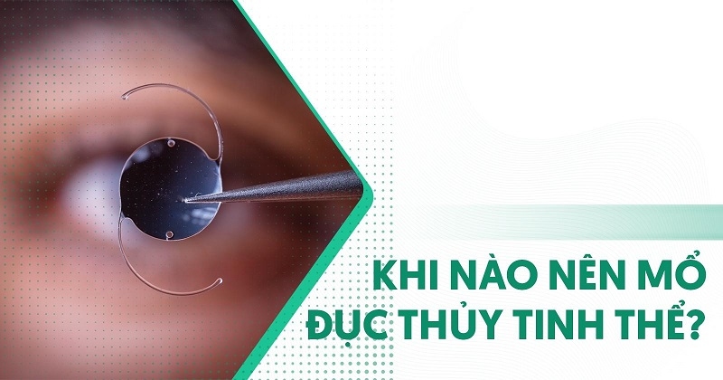khi nào nên mổ đục thủy tinh thể