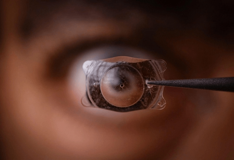 mổ mắt loạn cận