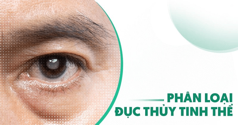 phân loại đục thủy tinh thể