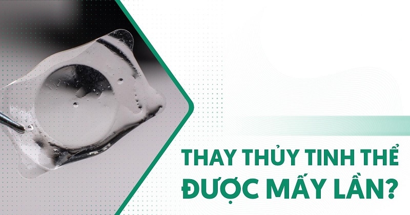 thay thủy tinh thể được mấy lần