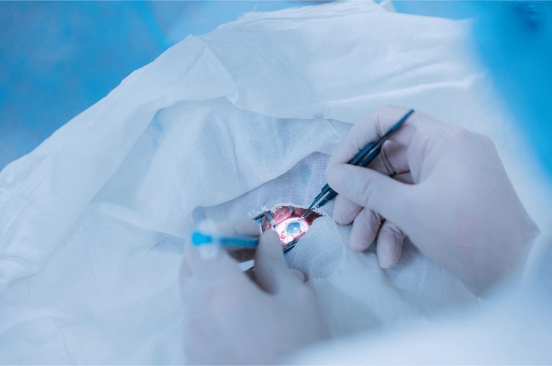 phương pháp mổ cận lasik