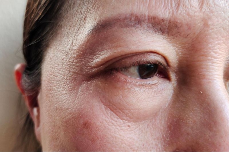 người bị sụp mí mắt