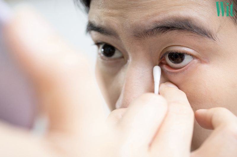 Dùng đầu tăm bông để lấy bụi bẩn trong mắt ra ngoài.