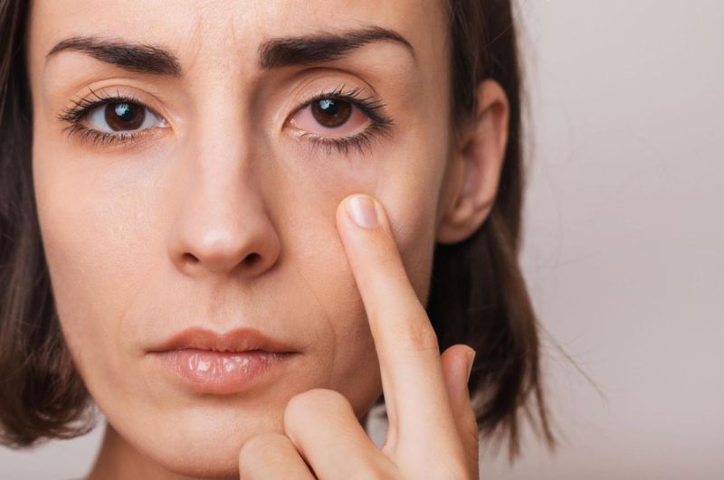 Khô mắt là tình trạng thường gặp phải khi đeo lens trong thời gian dài