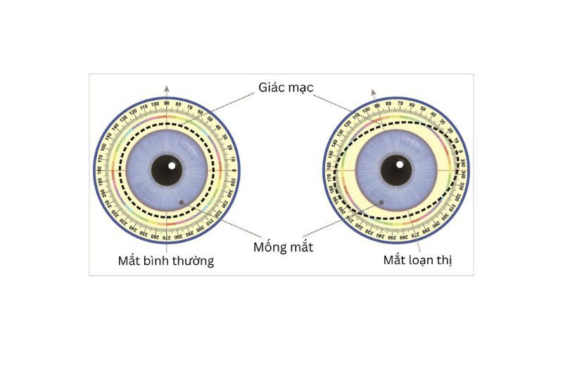 Giúp điều chỉnh thị lực