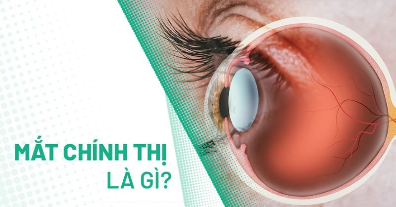 Mắt chính thị là gì? Cách nhận biết và đặc điểm