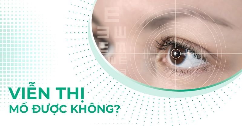 viễn thị có mổ được không