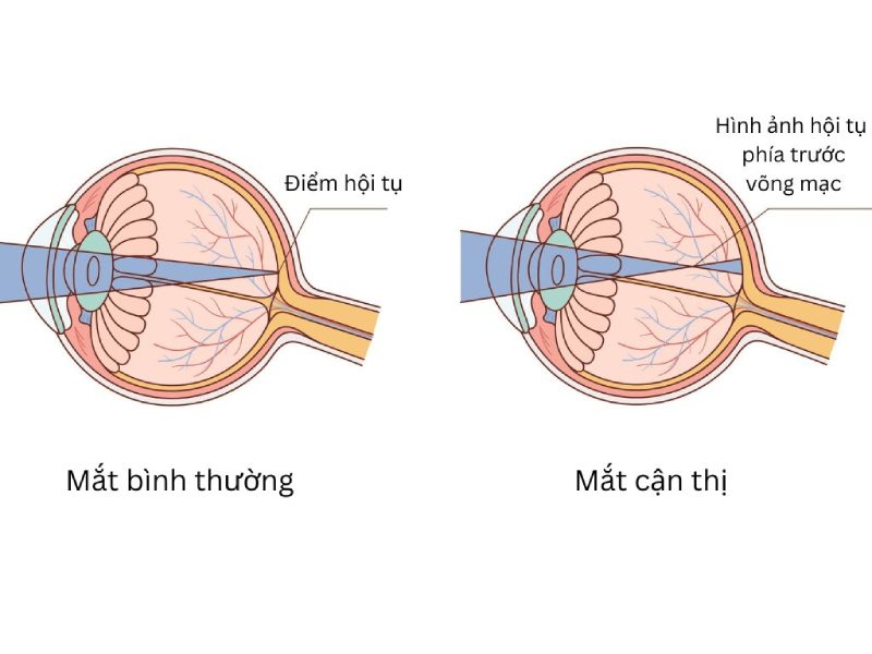 cấu tạo mắt cận thị